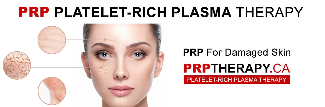 PRP-for-damaged-skin-header1