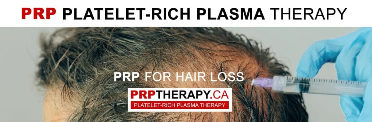 PRP hair treatment - PRP for hair loss