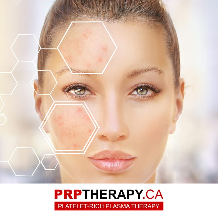 PRP for acne scars