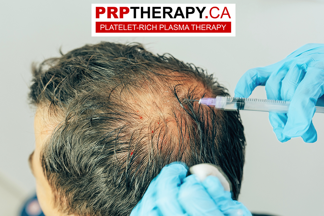 Platelet-Rich Plasma (PRP) Injection: How It Works