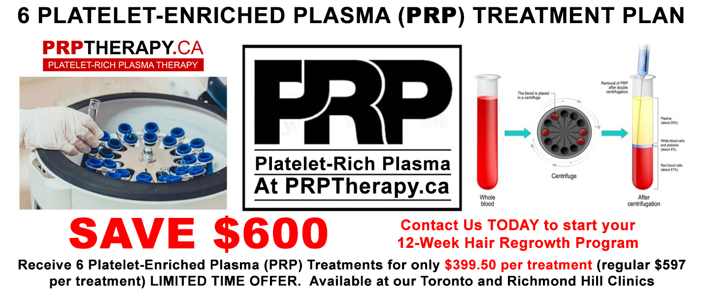 PRP therapy - PRP hair treatment Toronto - PRP Treatment
