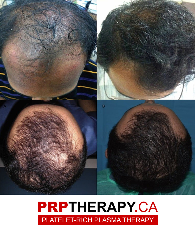 PRP for hair growth - PRP hair loss - PRP hair treatment