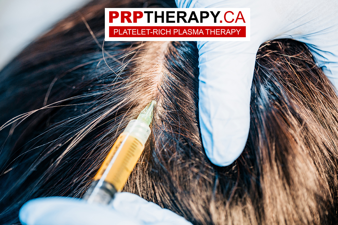 PRP hair treatment - PRP hair - PRP hair loss
