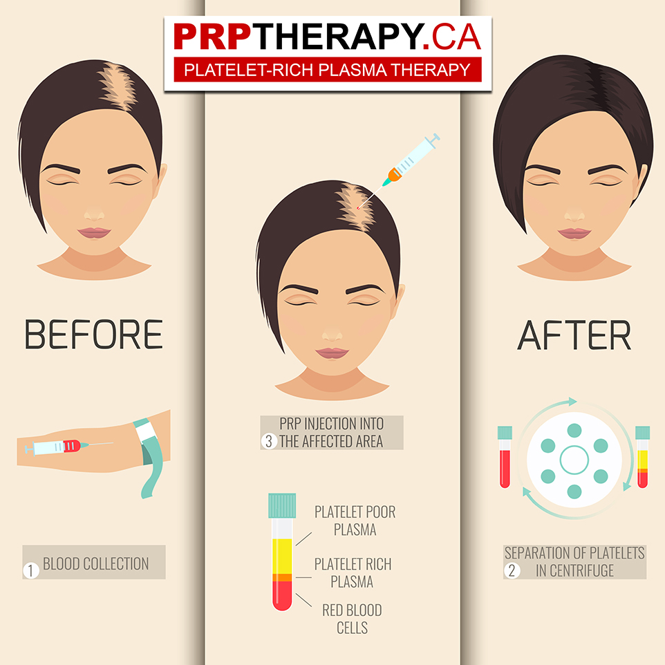 PRP hair treatment - PRP in hair treatment