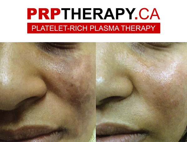 PRP near me - PRP toronto - PRP treatments