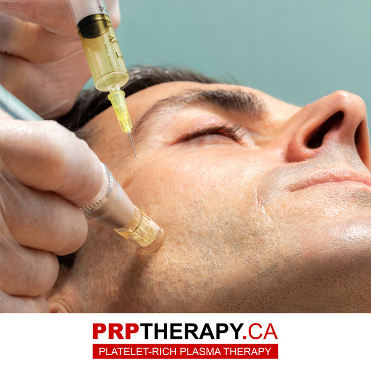 PRP treatment Toronto - PRP treatments near me - PRP treatments Toronto