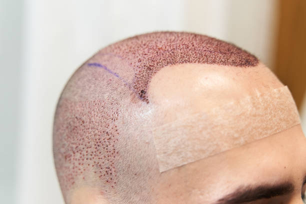 hair transplant vs PRP