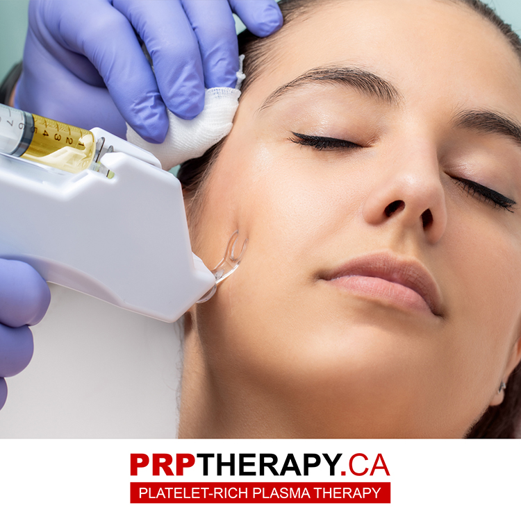 prp injection - inject prp - treatment prp - prp facial-Toronto