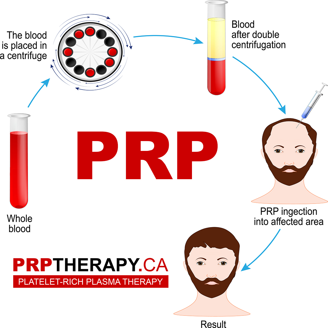 PRP treatment - PRP therapy - PRP in hair treatment Toronto